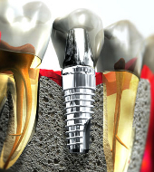 Маркетинговое исследование рынка стоматологических имплантатов
